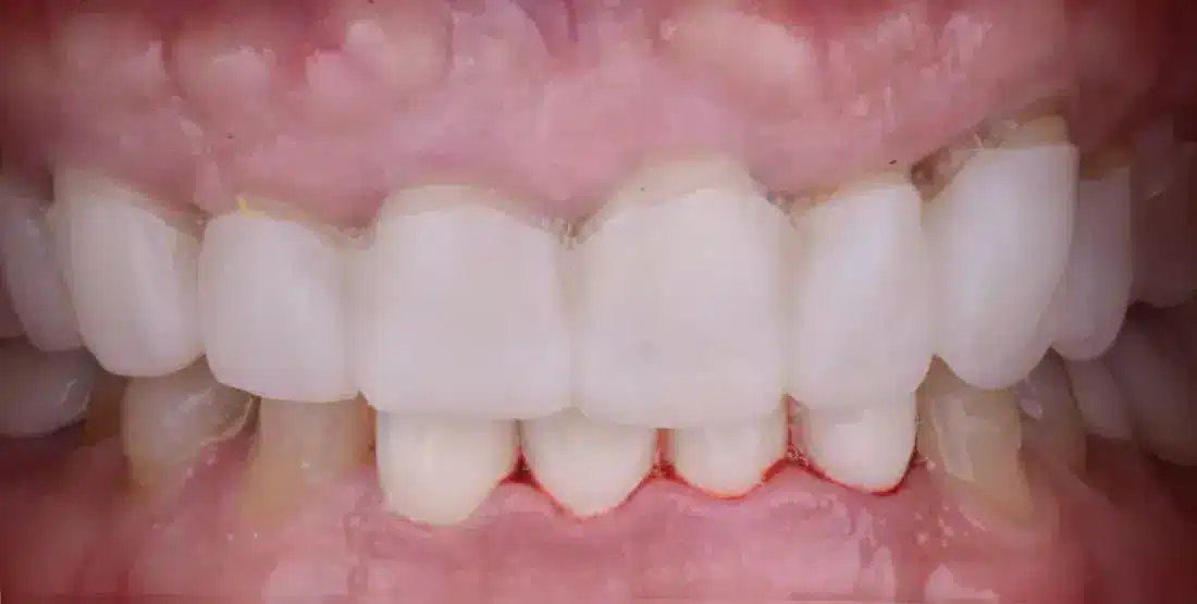 estetica dental antes