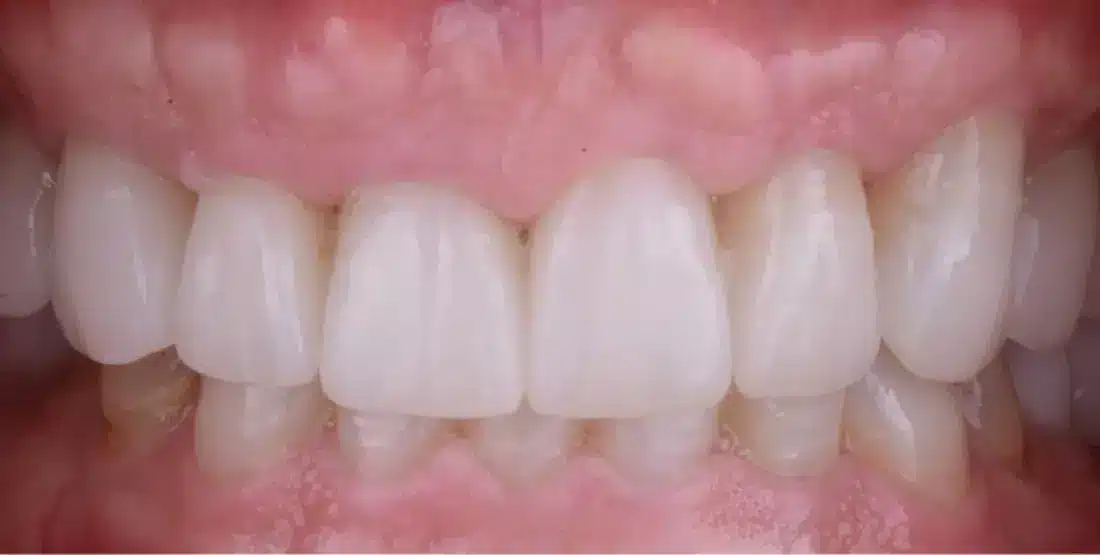 estetica dental despues 2